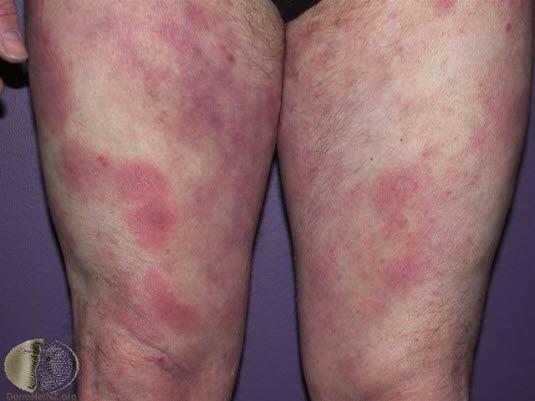 Mycosis fungoides, flekker