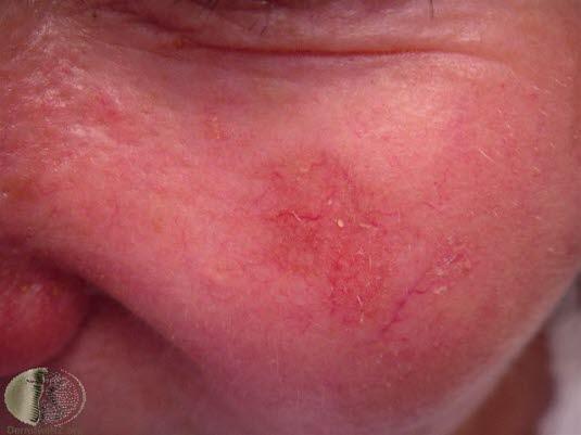 Aktinisk keratose, flate