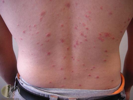 Pityriasis rosea, utslett