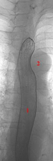 Røntgenbilde av normal tarm