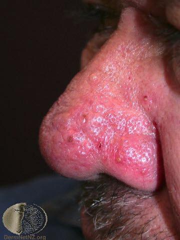 Rosacea, rhinophyma