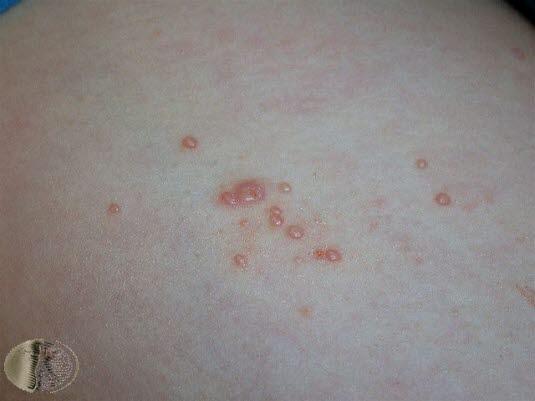 Molluscum contagiosum