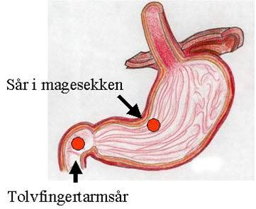 Magesår bilde#1 Magesår bilde#1