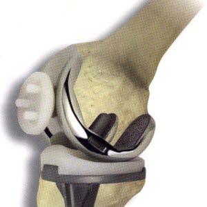 Fra Nasjonalt Register for Leddproteser