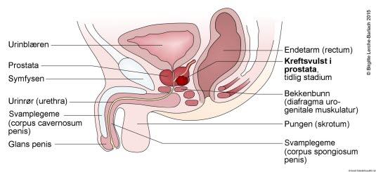 Kreftknute i prostata