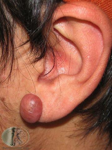 Keloid