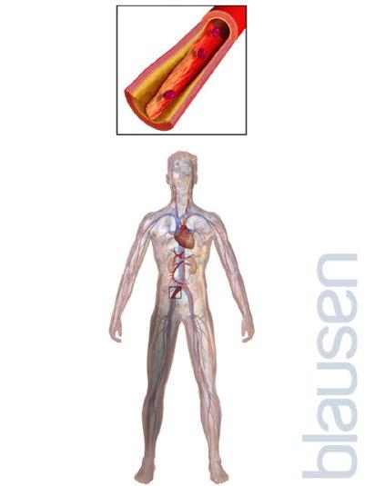 Claudicatio intemittens