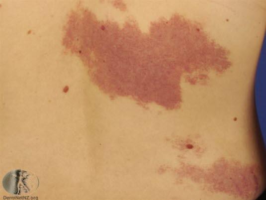 Hemangiom, regresjonsfase