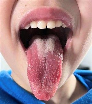 Jordbærtunge ved skarlagensfeber
