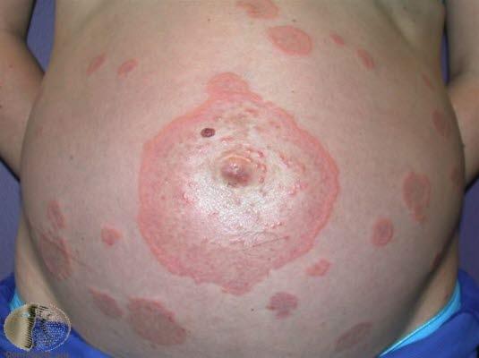 Svangerskaps-pemfigoid 1