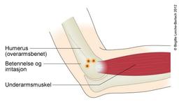 Lateral epikondylitt