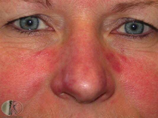 Rosacea, mild