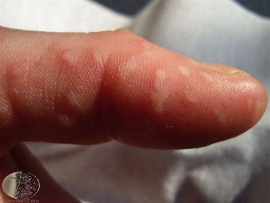 Hånd-, fot- og munnsykdom 1