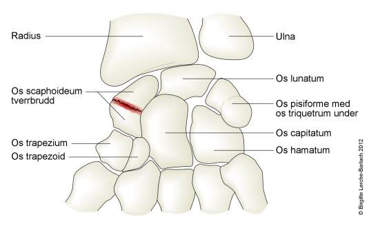 Brudd i båtbeinet, skafoidbeinet