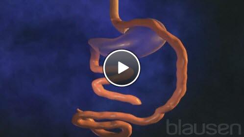 roux-en-y gastrisk bypass