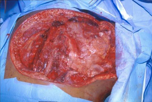 Sår med gassgangren