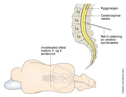 Ryggmargsvæskeprøve