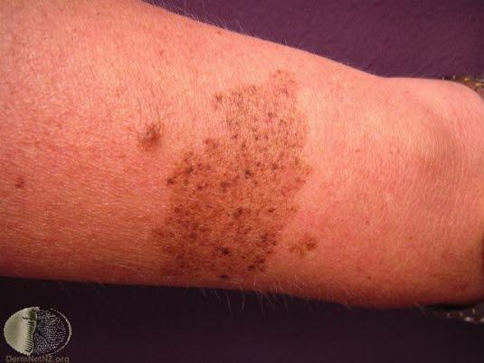 Nevus, kongenitt (spileus)