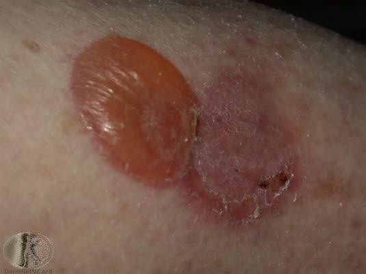 Pemfigoid, nærbilde