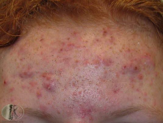 Akne, makrokomedoner