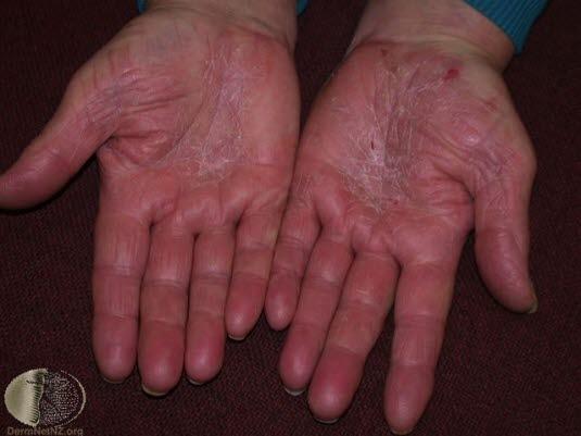 Kronisk dermatitt, hånd