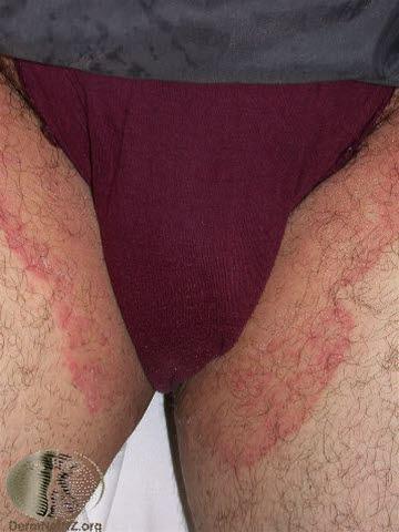 Tinea cruris