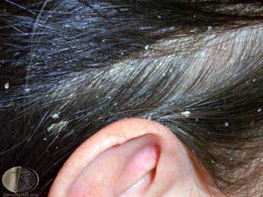 Seboroisk eksem, hodebunn