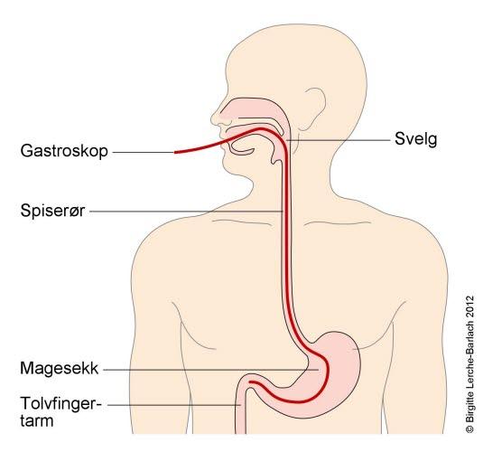 Gastroscopy