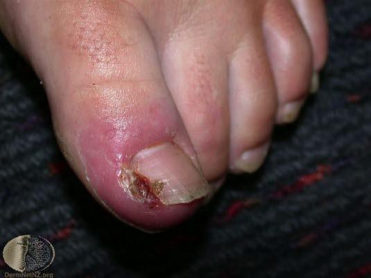 Inngrodd tånegl (betent) 2