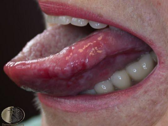 Oral lichen planus 2