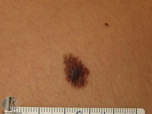 Nevus, irregulær