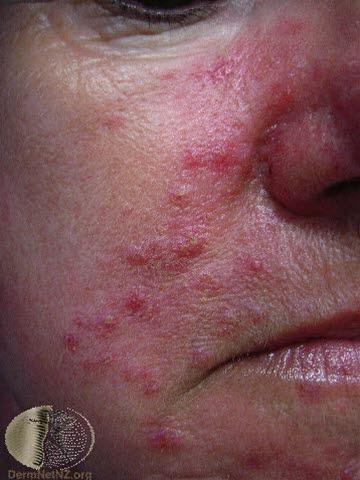 Rosacea, alvorlig