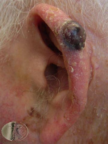 Malignt melanom, nodulært