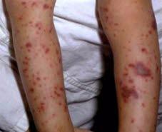 Petekkier (smittsom hjernehinnebetennelse)