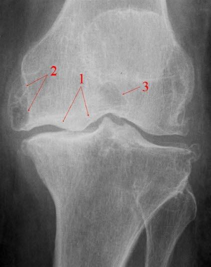 Uttalte slitasjeforandringer