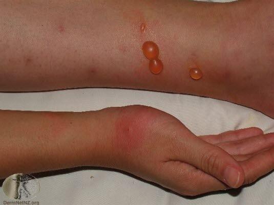 Myggstikk, bulløs reaksjon