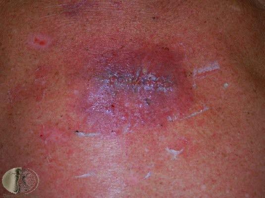 Kirurgisk sårinfeksjon