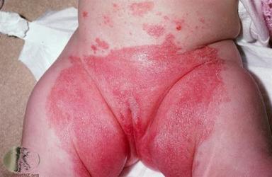 Bleiedermatitt, uttalt