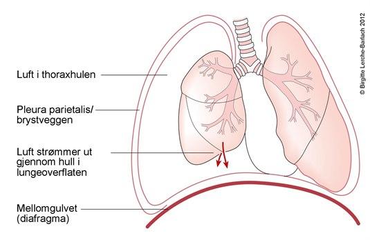 Pneumothorax - ventil Pneumothorax - ventil