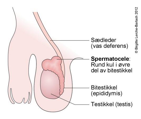 Scrotum - spermatocele
