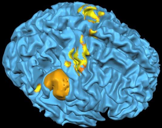 Funksjonell MR viser hvordan områder for spesifikk hjerneaktivitet (lys gul) ligger i forhold til svulsten (mørk gul).