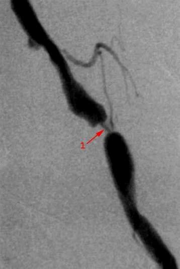 Angiografi som viser trangt parti i arterie