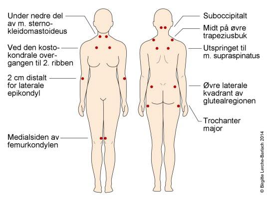 Tenderpunkter ved fibromyalgi
