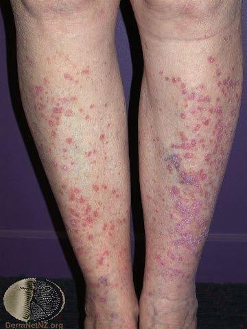 Lichen planus, legg