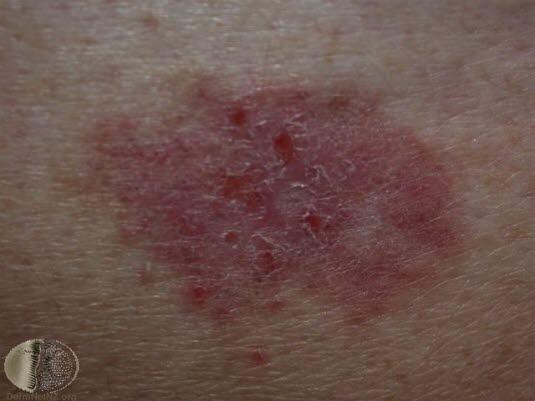 Basaliom, overflatisk