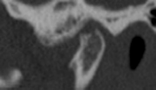 Kjeveleddsosteoartritt, jente 13 år. Foto: Avdeling for kjeve- og ansiktsradiologi, UiO/OD