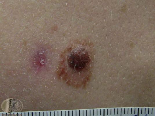 Nevus, atypisk