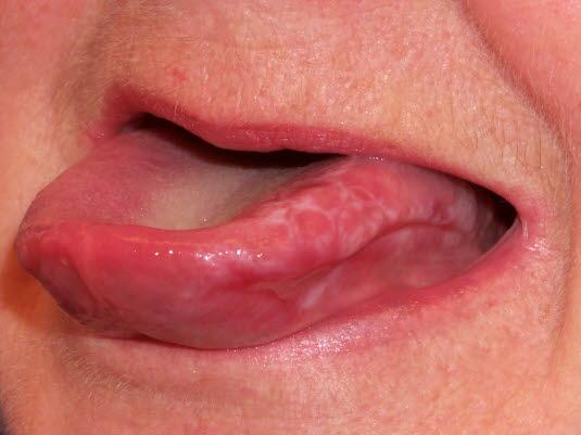 Oral lichen planus, erosiv type