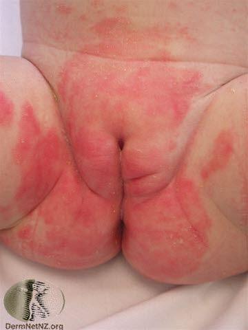 Bleiedermatitt, vanlig