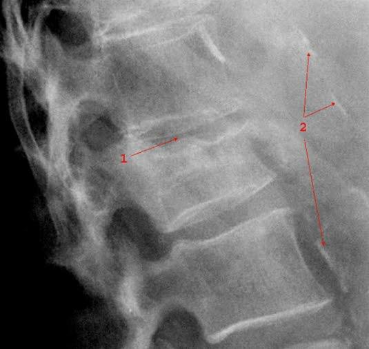 Brudd i ryggvirvel, sammenpresset virvel Brudd i ryggvirvel, sammenpresset virvel